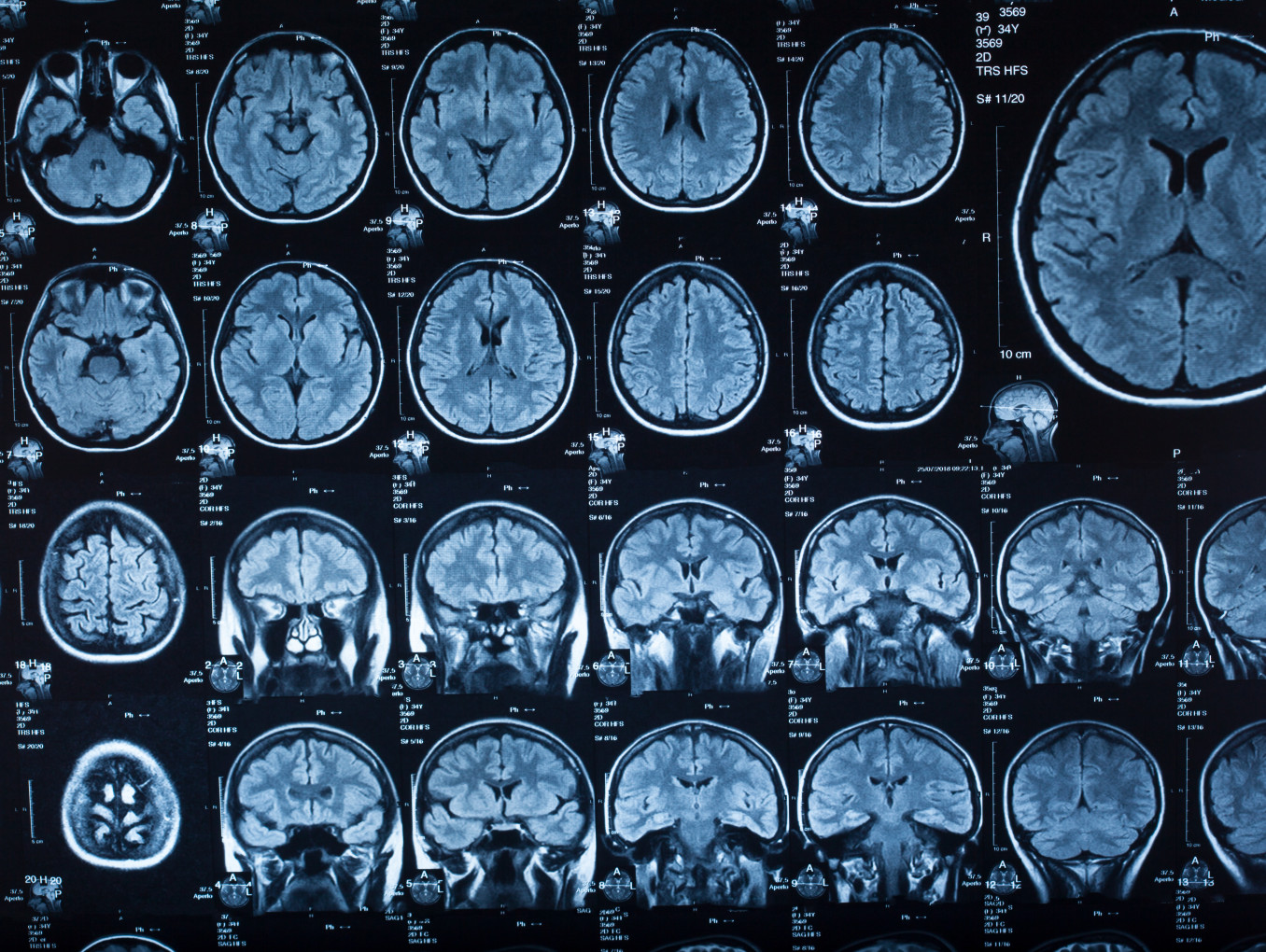 Brain CT Scans