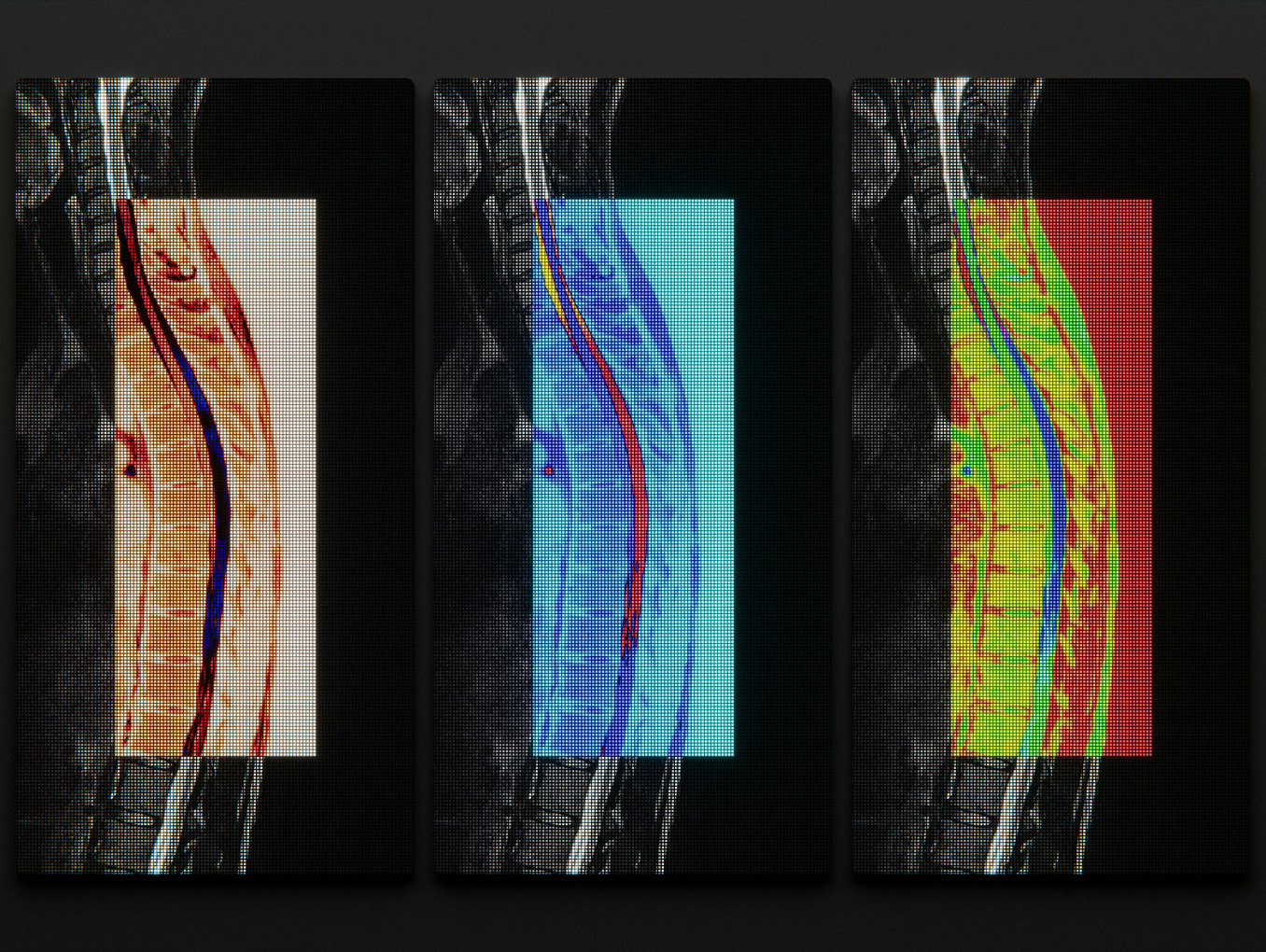 Three MRI scans of a human spine with overlaid PET scans.