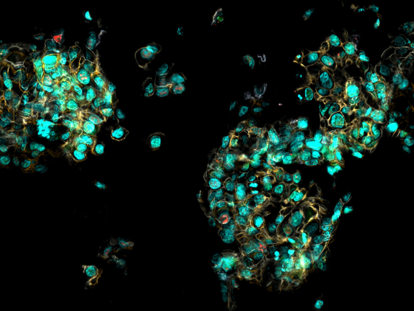 Organoid from breast cancer cells