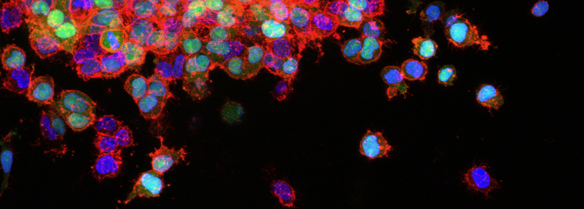 Cancer cells under the microscope