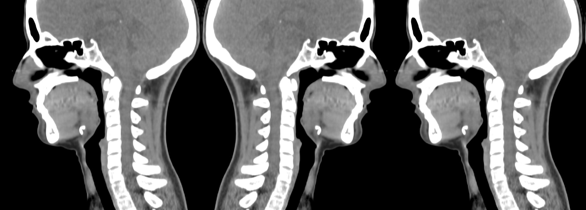Three side-view CT scans of the head and neck arranged as a triptych, with the central image engaging one profile while turning away from the other