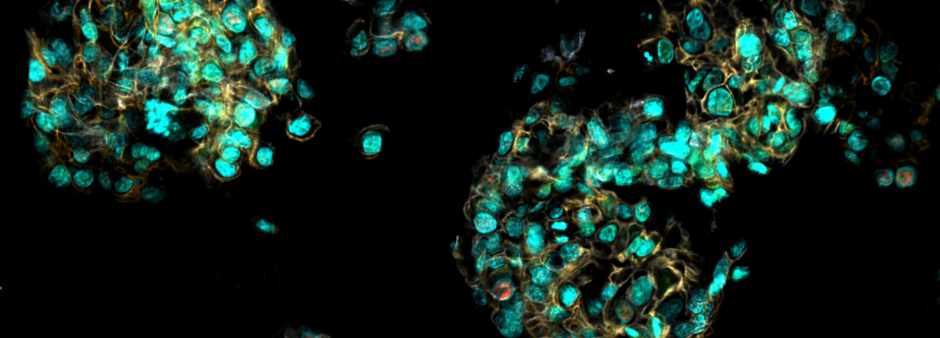 Organoid from breast cancer cells
