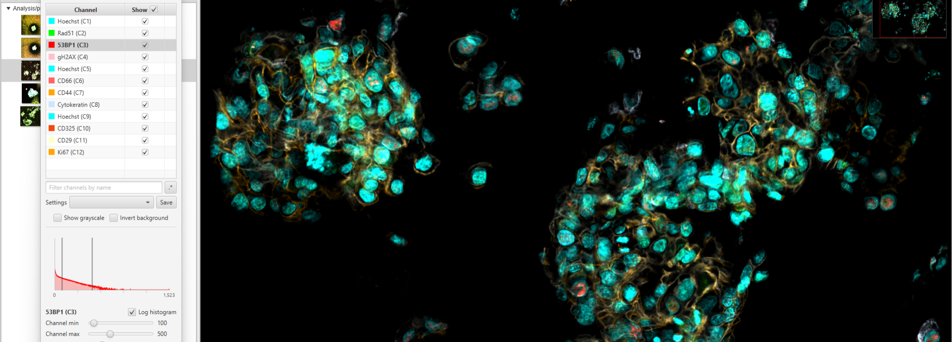 Organoid from  breast cancer cells