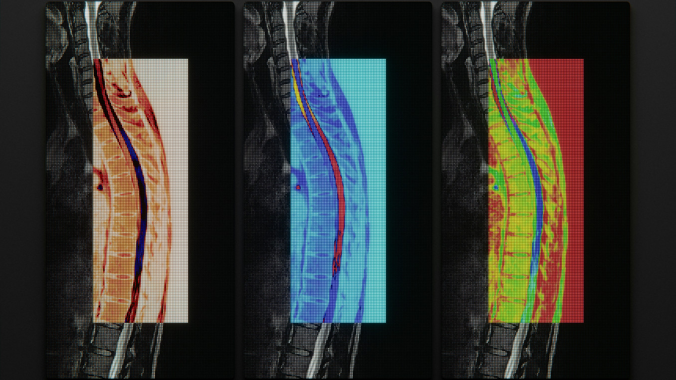 Three MRI scans of a human spine with overlaid PET scans.