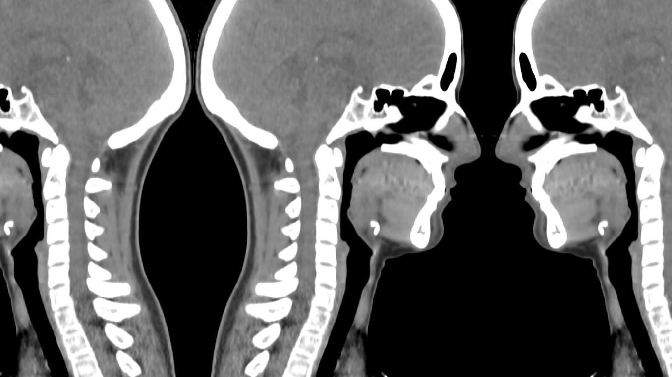 Three side-view CT scans of the head and neck arranged as a triptych, with the central image engaging one profile while turning away from the other