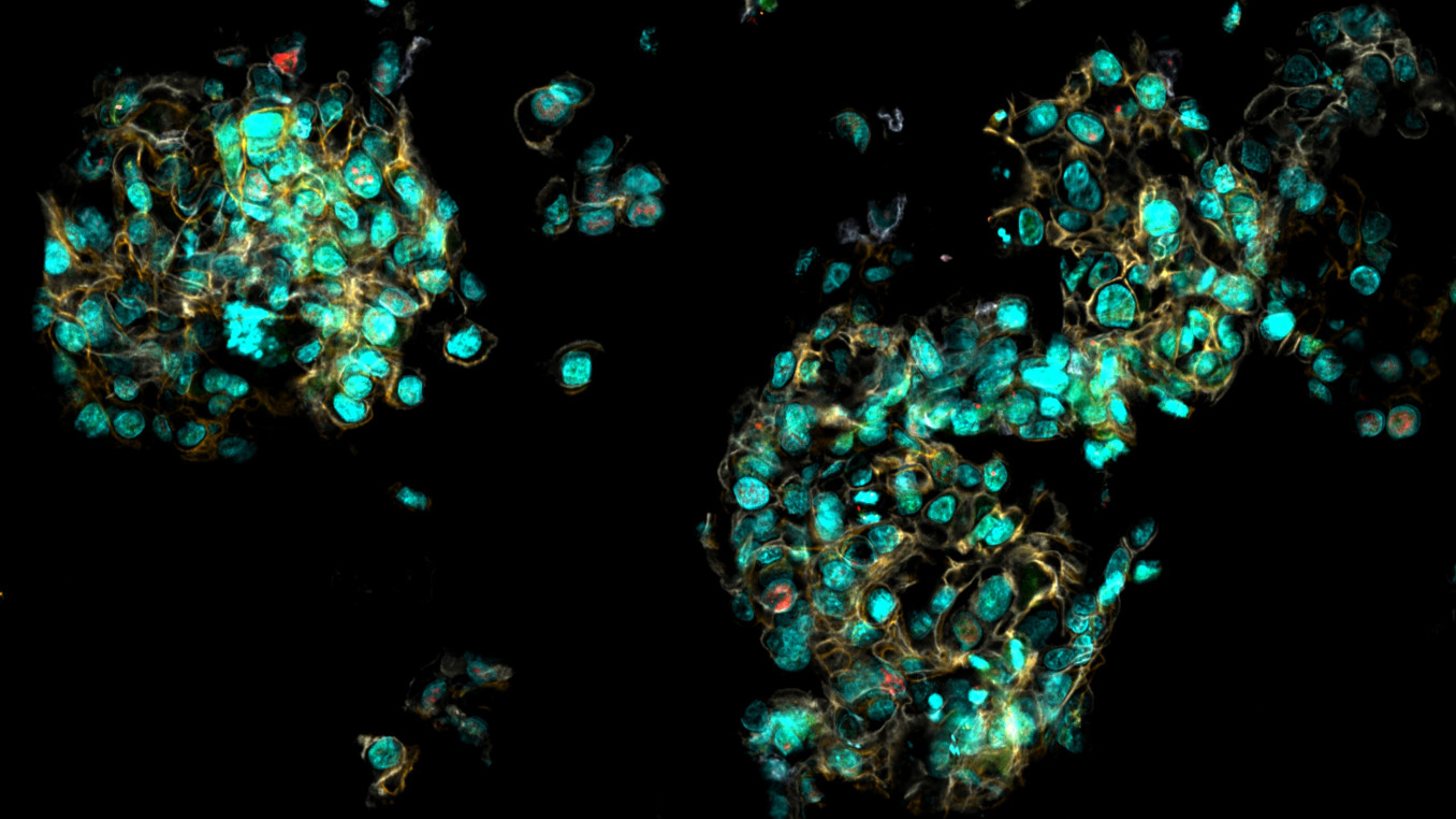 Organoid from breast cancer cells