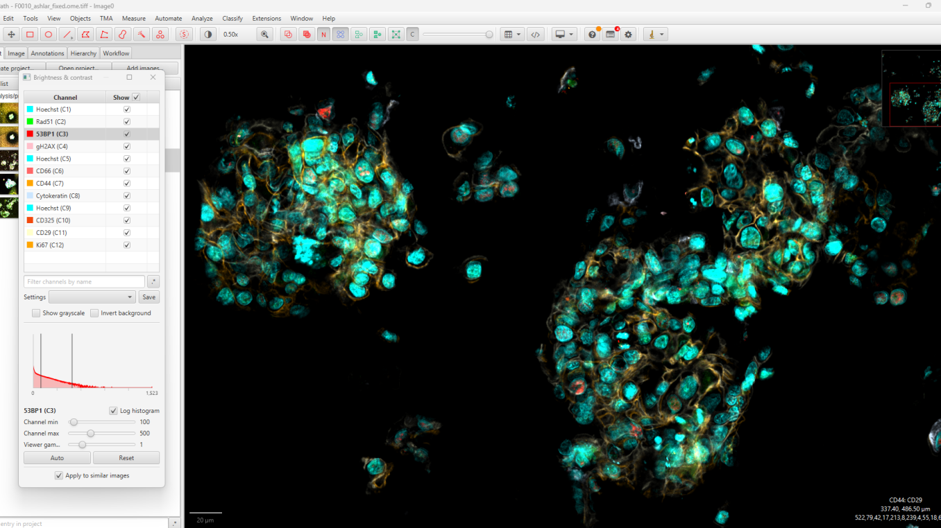 Organoid from  breast cancer cells